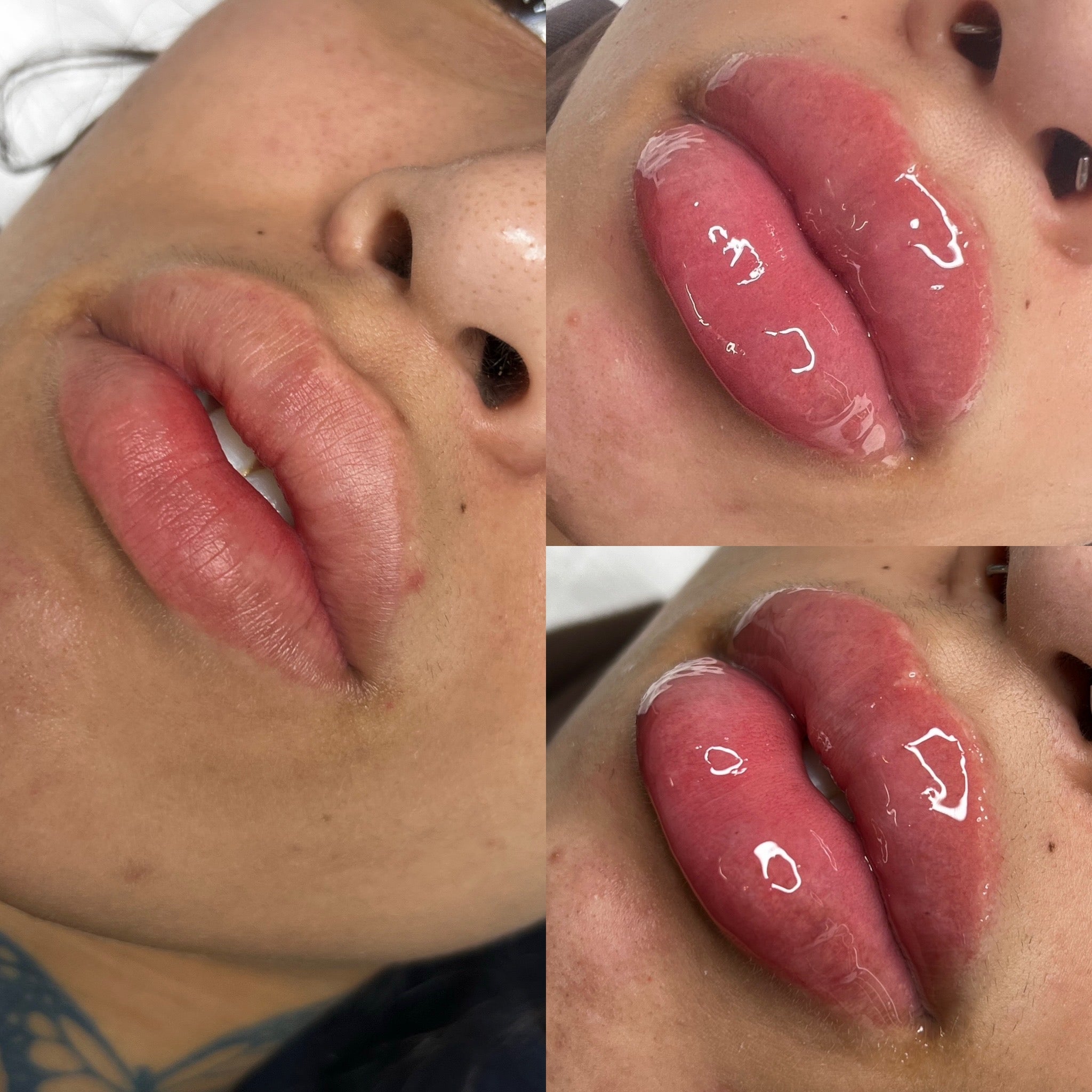 1-1 ATL Noninvasive Lip filler Training