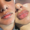 1-1 ATL Noninvasive Lip filler Training